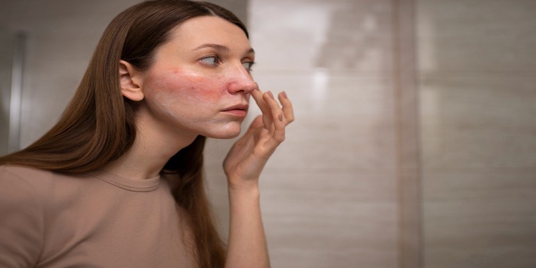 ¿Enrojecimiento facial? Descubre si es cuperosis o rosácea